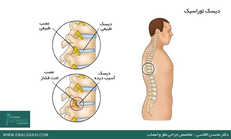 دیسک توراسیک (Thoracic Disc)