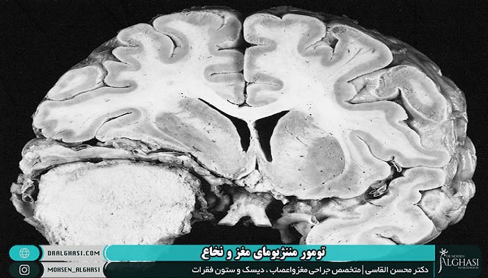 ساختار تومورهای مننژیومای مغز و نخاع