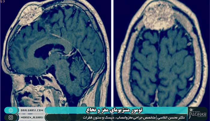 انواع تومورهای مننژیومای مغز و نخاع