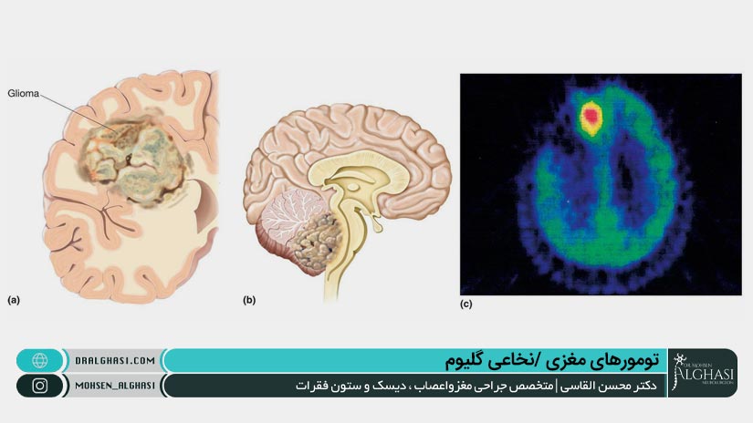تومورهای مغزی /نخاعی گلیوم چیستند؟