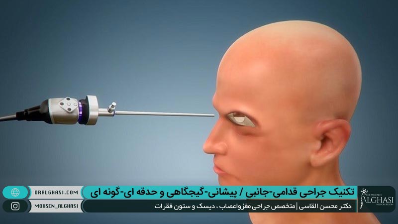 روش جراحی قدامی-جانبی / پیشانی-گیجگاهی و حدقه ای-گونه ای
