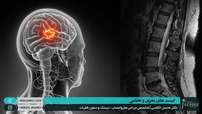 کیست مغزی و نخاعی