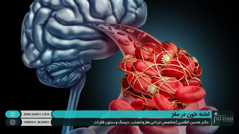لخته خون در مغز چرا اتفاق می افتد و درمان آن چیست؟