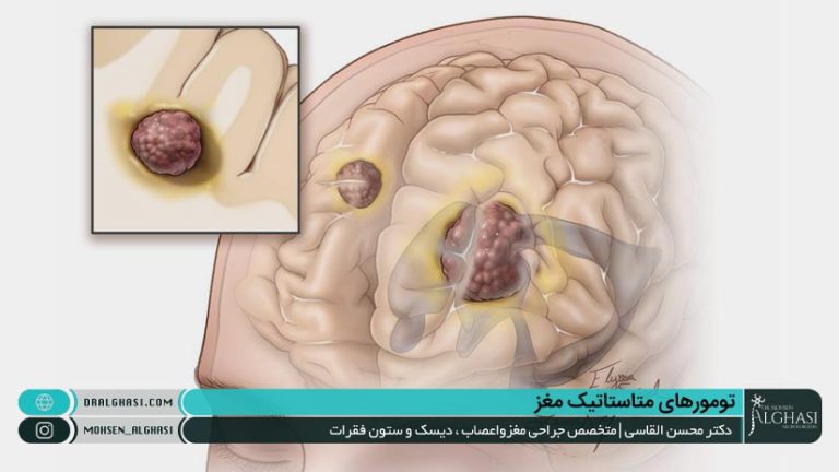 تومور مغزی متاستاتیک چیست؟