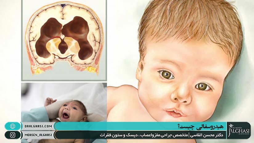 هیدروسفالی چه نوع بیماری است؟