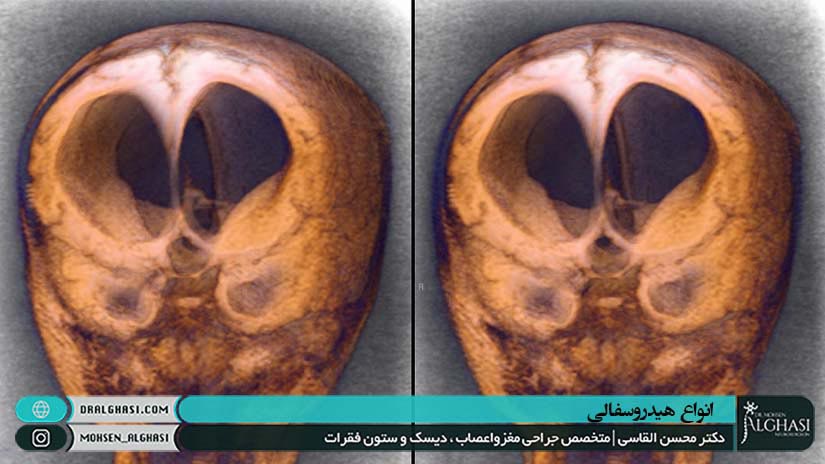 انواع بیماری هیدروسفالی