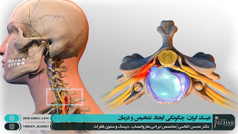 تشخیص و درمان دیسک گردن
