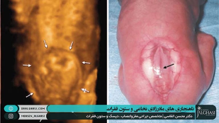 ناهنجاری های مادرزادی نخاعی و ستون فقرات