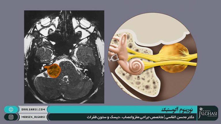 نورینوم آکوستیک یا نوروم آکوستیک