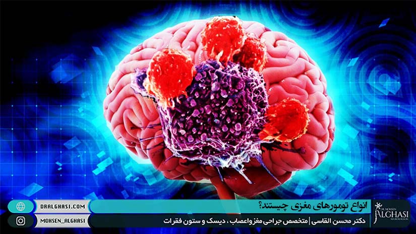 انواع تومورهای مغزی