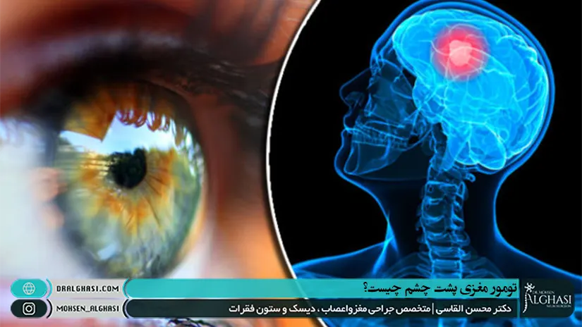 تومور مغزی پشت چشم چیست؟