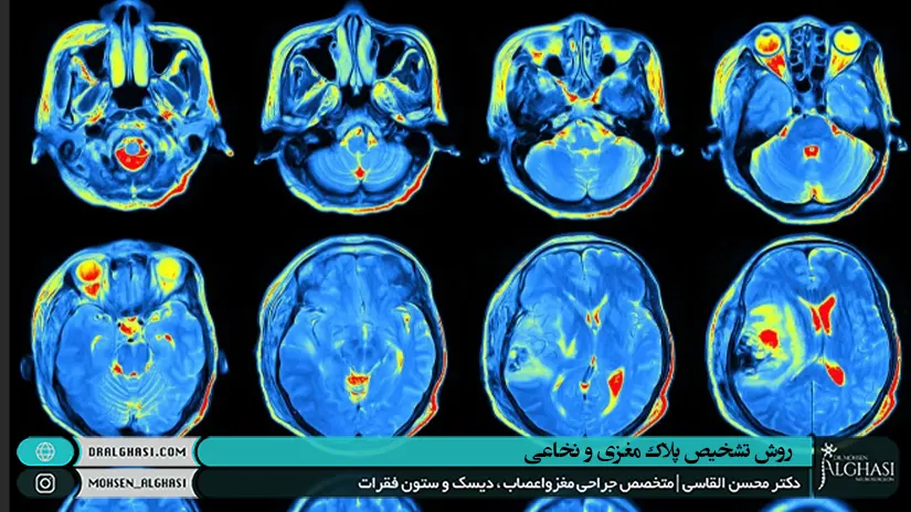 روش تشخیص پلاک مغزی و نخاعی