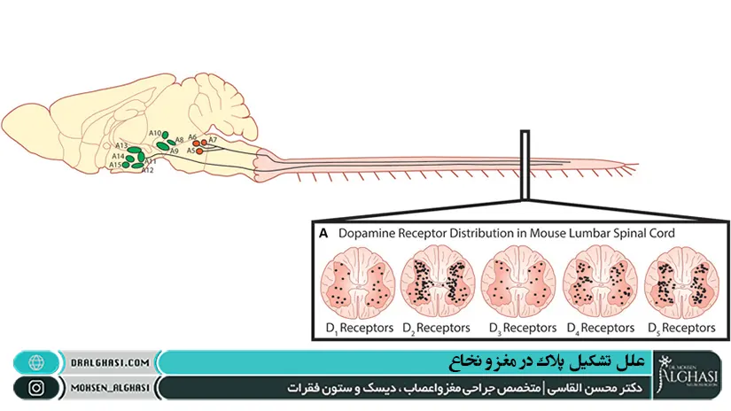 علت تشکیل پلاک مغزی نخاعی