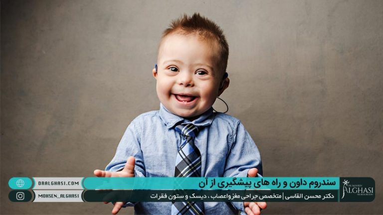 سندروم داون