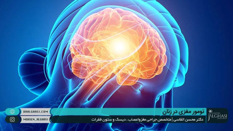 درمان تومور مغزی در زنان
