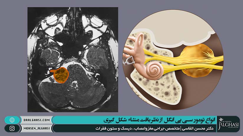 درمان جراحی تومور سی پی انگل