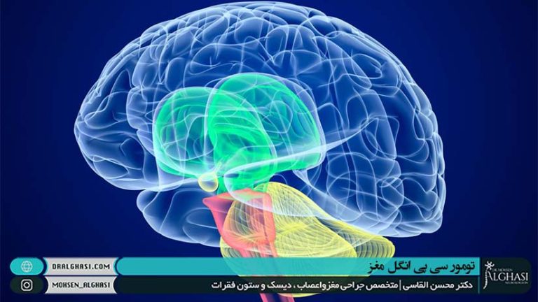 تومور سی پی انگل