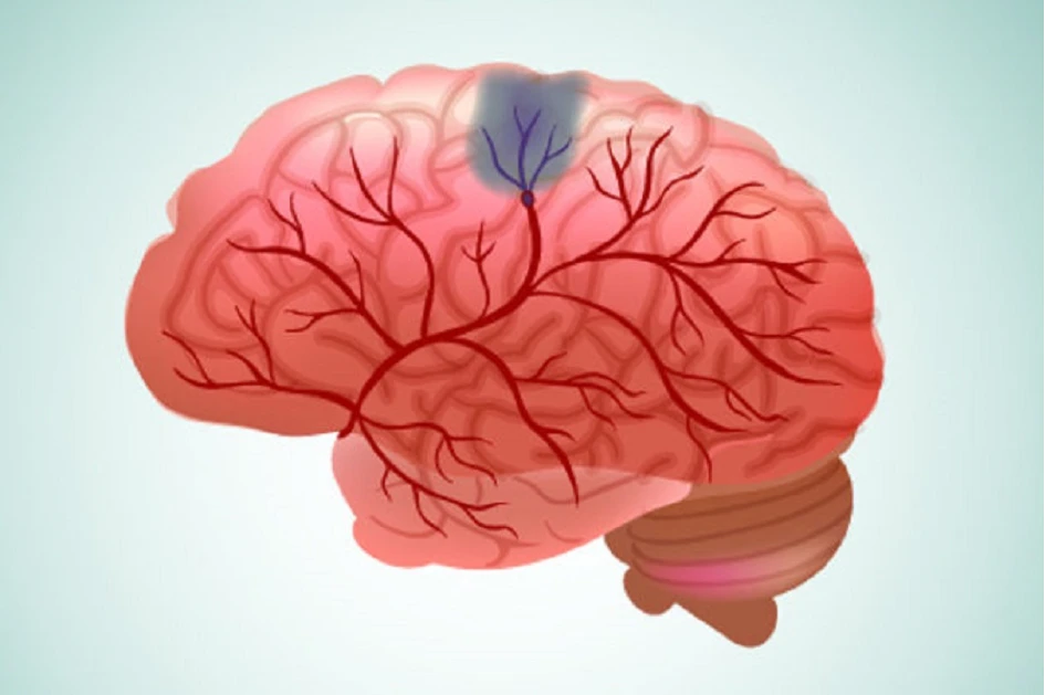 بیماری‌خای مغز | طول عمر افراد مبتلا به متاستاز مغزی | دکتر القاسی