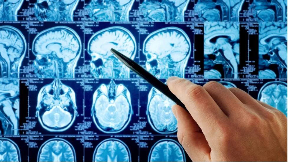 تشخیص انواع تومور مغزی | دکتر محسن القاسی