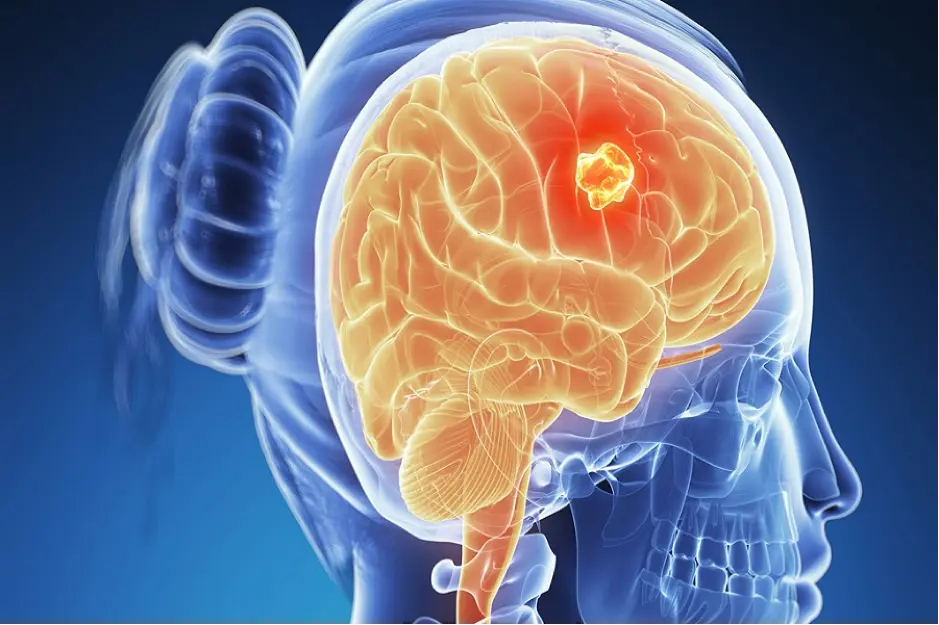 بدترین نوع نومور مغزی | دکتر القاسی | بیماری های مغز