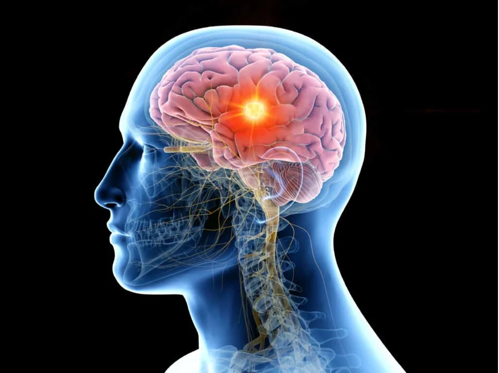 تومورهای مغزی | انواع تومور مغزی | دکتر محسن القاسی