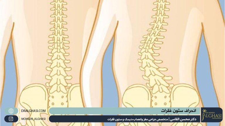 انحراف ستون فقرات | دکتر القاسی | بهترین متخصص مغز و ستونفقرات