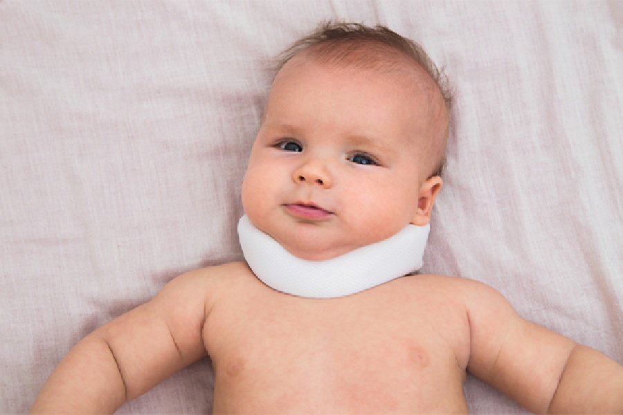 سندروم کلیپل فایل یا کوتاهی گردن نوزادان | دکتر القاسی | بهترین جراح ستون فقرات تهران
