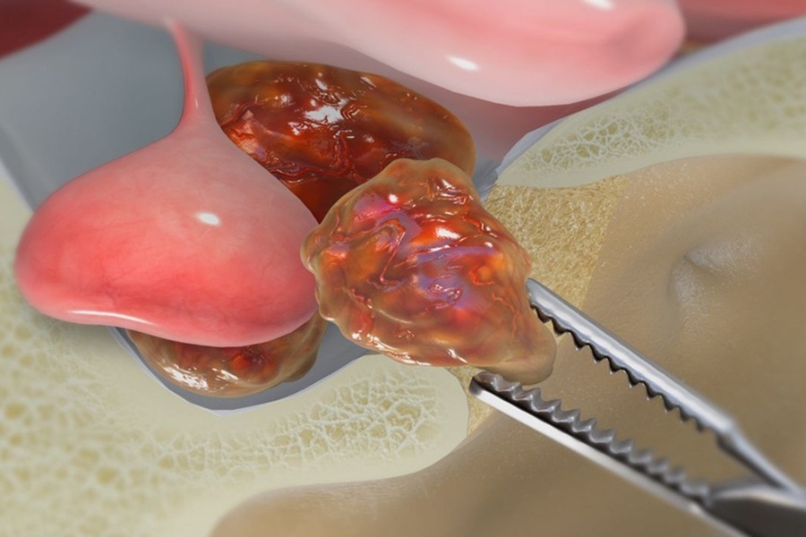 تومور | دکتر القاسی | بهترین جراج مغز و اعصاب | بهترین جراخ تومور