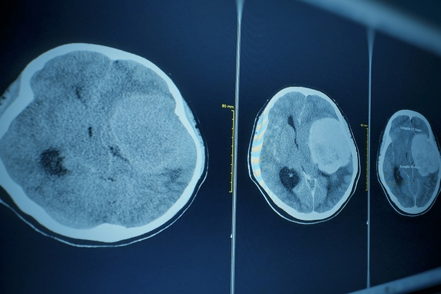 درمان تومور | دکتر القاسی | بهترین جراح تومور