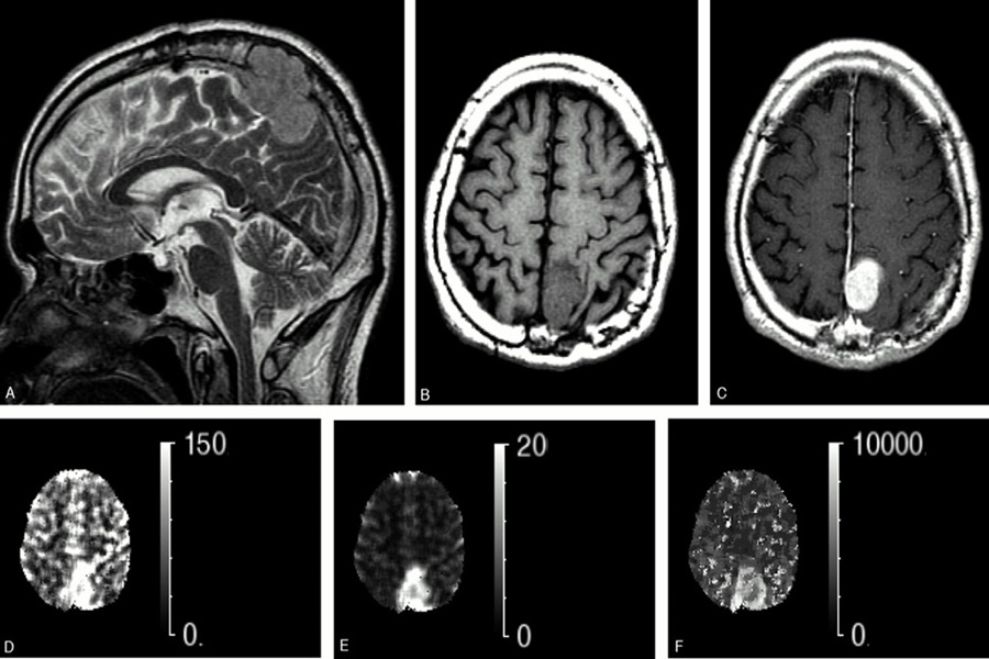 تومور بدخیم سرطانی | دکتر القاسی | بهترین جراح تومور