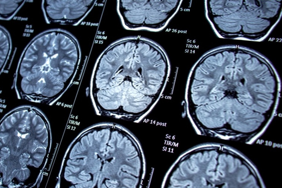 تومور سی پی انگل | دکتر القاسی | بهترین جراح تومور