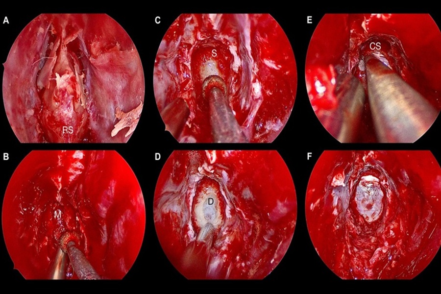 تومور هیپوفیز | دکتر القاسی | بهترین جراح تومور